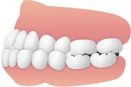 上下顎前突(じょうげがくぜんとつ)