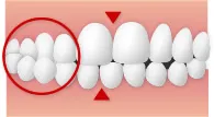 交差咬合(こうさこうごう)