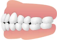 切端咬合(せったんこうごう)
