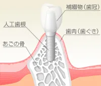 インプラント