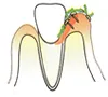 ②炎症が起こることにより歯茎が腫れてしまい、歯と歯茎の間の溝が汚れやすくなり、カビが奥で炎症を起こします。