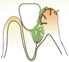 ④歯周ポケットが更に深くなり、たくさんの菌が溜まっていき、骨を溶かしていきます。