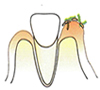 ⑤骨が溶けることにより歯周ポケットはますます深くになり、多くの菌が溜まっていきます。