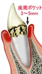 軽度歯肉炎（歯肉ポケット 3～5mm）